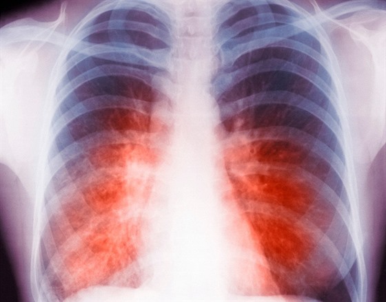 Rentgenový snímek plic eny, která onemocnla tuberkulózou.