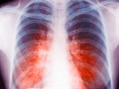 Rentgenový snímek plic �eny, která onemocn�la tuberkulózou.