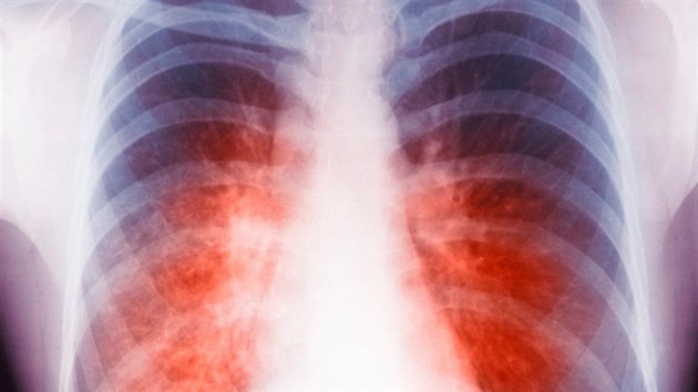 Rentgenový snímek plic ženy, která onemocněla tuberkulózou.