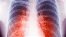 Rentgenový snímek plic eny, která onemocnla tuberkulózou.