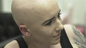 Barbora o alopecii: Za holou hlavu se nestydím