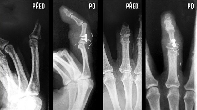 Rentgenový snímek pravé ruky Hany Kolouškové před a po operaci, při které jí tým lékařů nahradil část prostředníčku ukousnutou psem prstem z nohy.