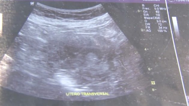 Ultrazvuk, který dokazuje, že 70letá Maria je těhotná. „Lékaři ani já jsme tomu nemohli uvěřit,“ říká.