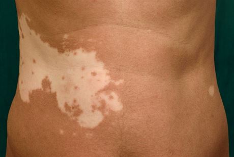 Svtl nepravideln skvrny na ki, odborn vitiligo, mohou bt projevem...