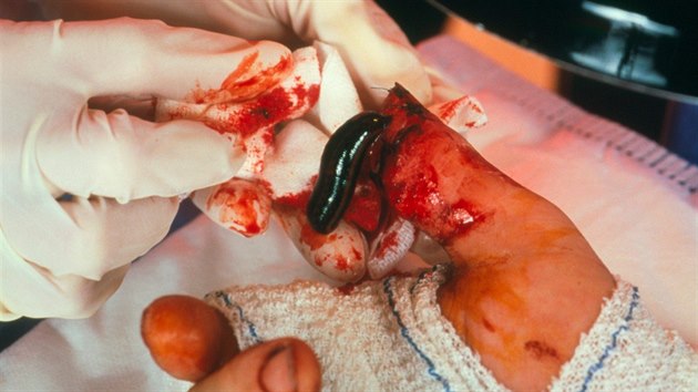 Na snímku lékaři použili pijavici u pacienta, který měl těžce poškozený palec.