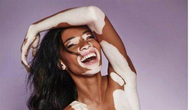 Modelka Winnie Harlowová má poruchu kožního pigmentu známou jako vitiligo. Přesto nemá o zakázky nouzi. Stala se například tváří kampaně španělské značky Desigual.