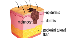 Melanom