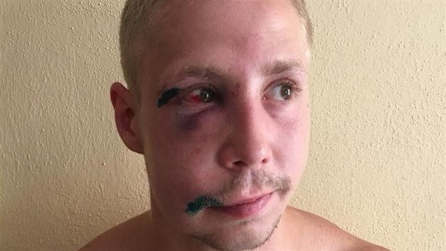 Opuchlá tvář, podlitina pod okem, sešité víčko a ústní koutek - tak vypadal po ošetření u lékaře pětadvacetiletý mladík, kterého zbili na koupališti v Dubí.