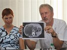 Prim Petr Kmpel ukazuje CT snmek jater napadench tasemnic li. 