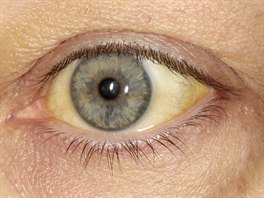 Jedním z projev� hepatitidy m��e být ze�loutlé b�lmo.