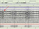 EEG zaznamenané bhem spánku ukazuje pomalé spánkové vlny. Spodní linka ukazuje...