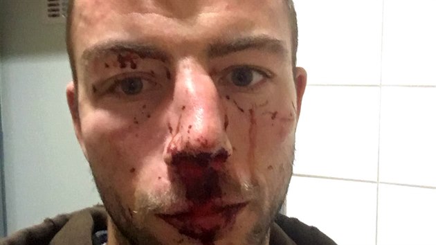 Michal Hlinka měl po napadení zakrvácený obličej.
