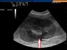 Ultrazvuk posledního stádia chronické nemoci ledvin