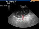 Ultrazvuk normální ledviny