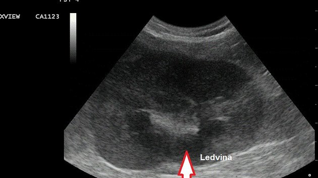 Ultrazvuk poslednho stdia chronick nemoci ledvin