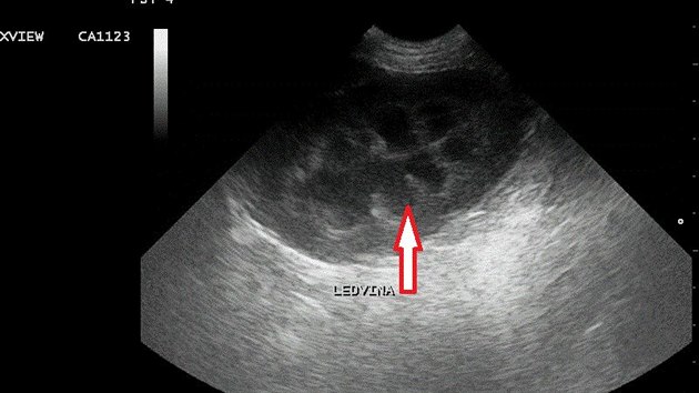 Ultrazvuk normln ledviny