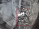Záhadný pedmt, který zvíecí záchranái odhalili pi rentgenování v zaívacím...