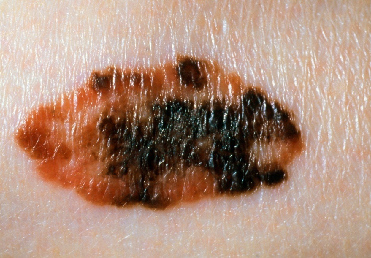 OBRAZEM: Takto vypadá rakovina kůže. Znaménka mění barvu, tvar i velikost
