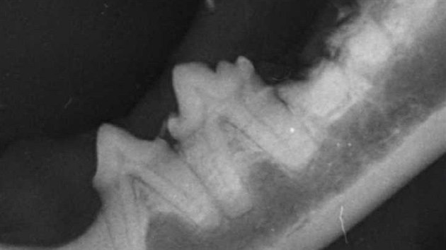 Zlomenina korunky zubu se subgingivln (pod rovn dsn) lokalizovanmi zbytky koen zubu spodn elisti koky