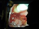 Unikátní zákrok za pouití endoskopu