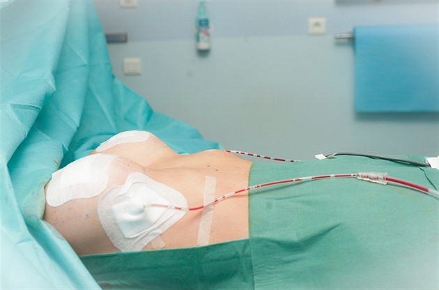 Mámy na plastiku nemají. Zákroky pojišťovna hradí jen ze zdravotních či psychických důvodů