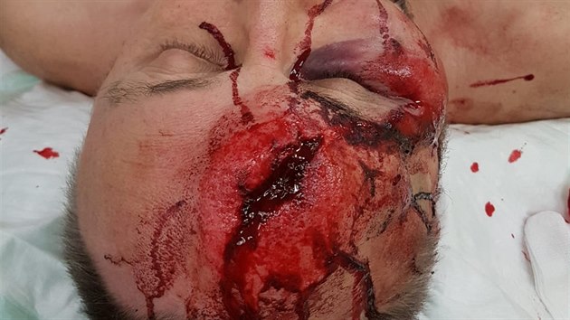 Zrann poslanec a f Alternativy pro Nmecko (AfD) v Brmch Frank Magnitz po napaden neznmmi tonky (8.1.2018) 