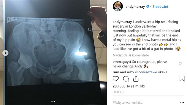 Tenista Andy Murray sdílel rentgenový snímek po operaci kyčelního kloubu, na kterém je zřetelně vidět i jeho penis (29. 1. 2019)