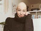 Agta Ulrichov trp alopeci universalis, nemoc, pi kter pacient pijde...