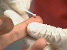 Britským lékam se podailo vyléit druhého pacienta s HIV