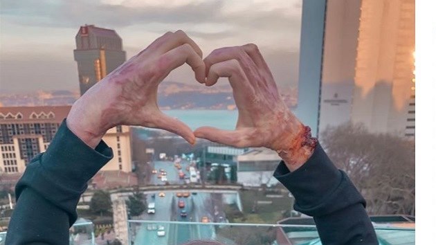 Kristýna Třešničková sdílela na Instagramu fotografii aktuálního stavu svých popálených rukou (březen 2019).