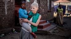 Albínské děti v Africe.