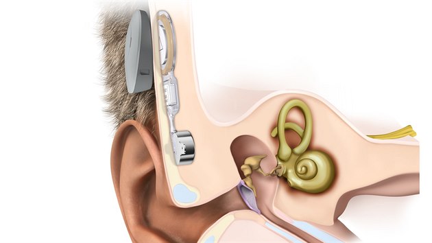 Un implantt bonebridge je voperovn pod ki do leben kosti. Zvenku na hlav za uchem se pak pomoc magnetu pikld jen procesor, kter snm zvukov vlny.