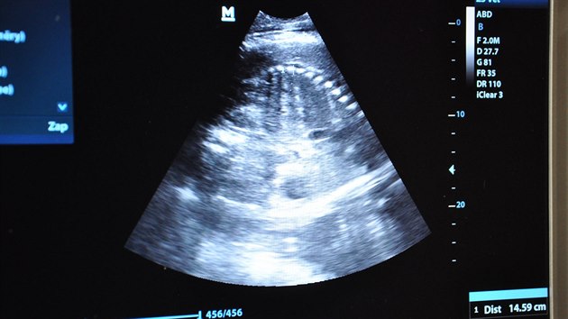 Ob oekvan mlata byla v den vyeten iv a bez abnormalit. Na fotografii je ultrazvukov snmek z vyeten Janity z 24. dubna 2019.
