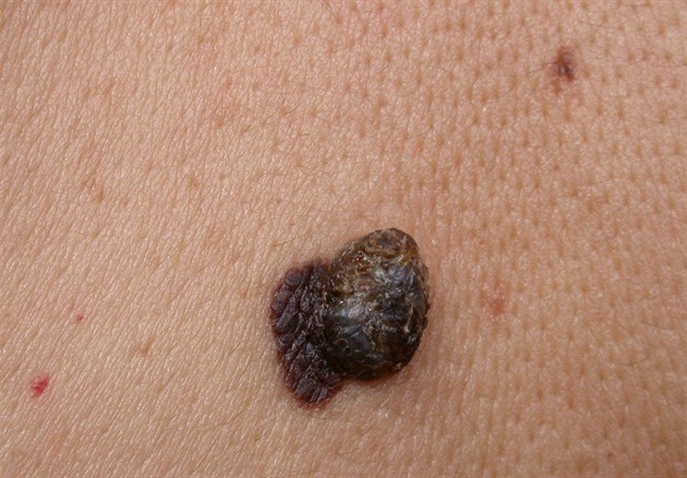 Lékař nerozpoznal zhoubný melanom. Po letech má pacient šanci na odškodnění