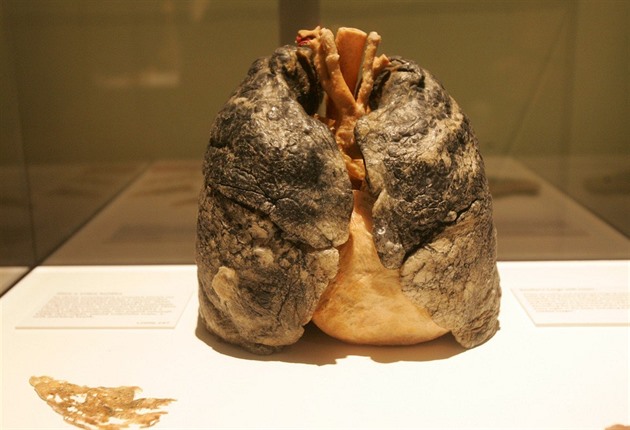 Na rakovinu plic se přichází pozdě. Lékaři chtějí nahnat kuřáky na screeningy