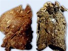 Zdravé plíce (vlevo) a plíce kuáka (vpravo)