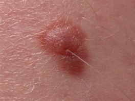 I takto může vypadat melanom. Tento je na noze – světlý s rozpitými okraji.
