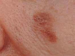 Nepravidelný melanom na obličeji, který je typický rozpitými okraji.