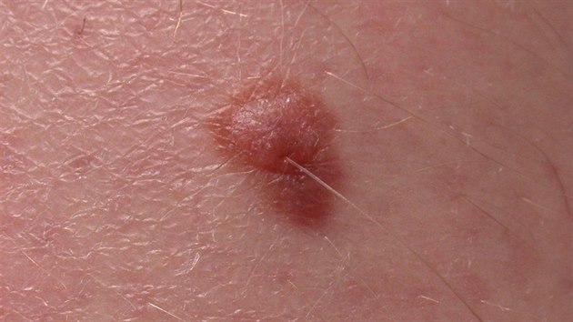 I takto me vypadat melanom. Tento je na noze  svtl s rozpitmi okraji.
