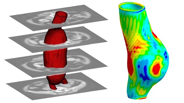 Rekonstrukce geometrie aortlnho aneurysmatu na zklad CT snmk pacienta a prbh prvnho hlavnho napt ve stn aneurysmatu, zatenho stednm arterilnm tlakem.