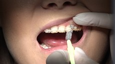 Dentální hygiena s rovnátky