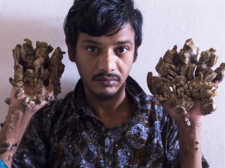 Bangladéšan Abul Badžandar, jehož končetiny kvůli kožnímu onemocnění...
