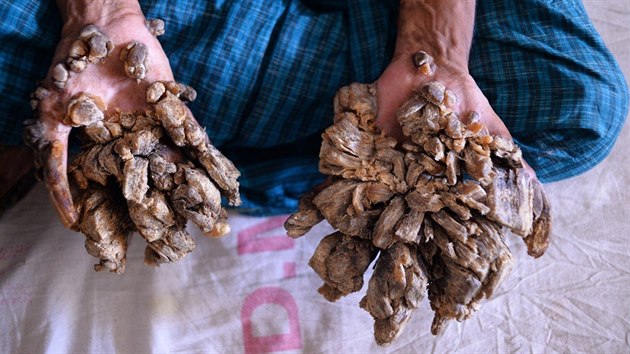 Bangladan Abul Badandar, jeho konetiny kvli konmu onemocnn pipomnaj kru stromu, oznmil, e si peje amputaci rukou, aby se zbavil nesnesiteln bolesti. (24. 6. 2019)