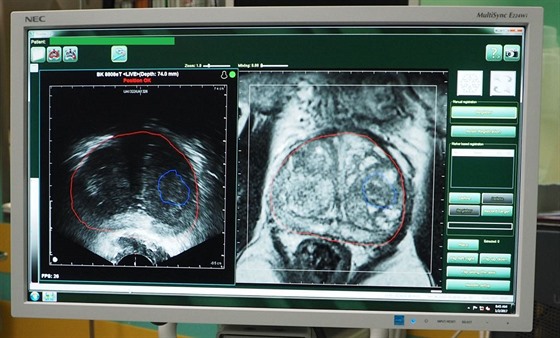 Softwarová fúze transrektální ultrasonografie (vlevo) a magnetické rezonance...