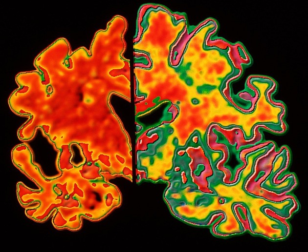 Alzheimerovu nemoc by mohl brzy odhalovat jednoduchý test