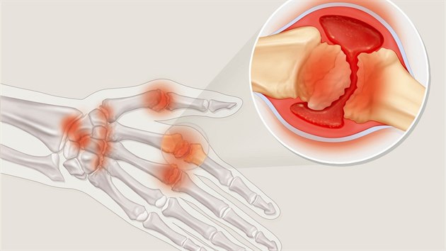 Nkres ruky pokozen revmatoidn artritidou