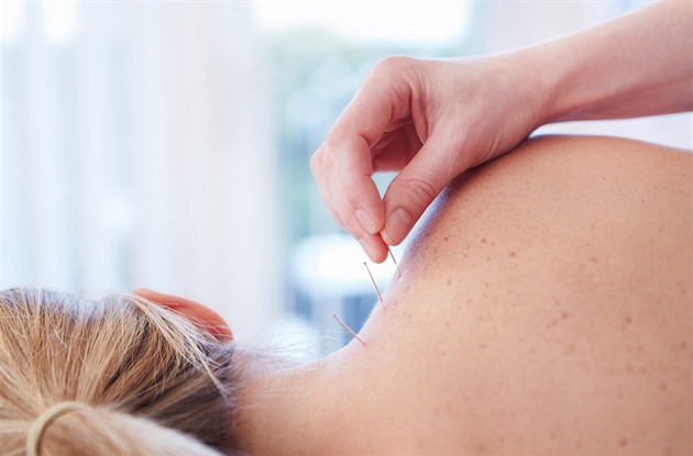 Akupunktura pomůže při bolesti zad i alergii, ale uleví i při stresu