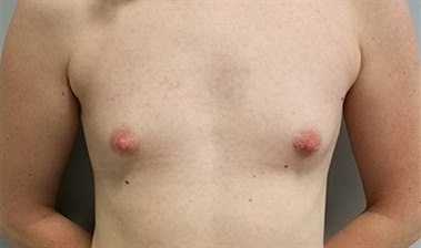 Některé ženy vedou k plastické operaci i psychické důvody. Lenka neměla vůbec žádná prsa a dlouho ji to trápilo. Proto se rozhodla pro augmentaci - zvětšení prsu pomocí implantátů.