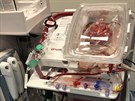 Lékaři z IKEMU využili novou metodu, která umožňuje převést pro transplantaci...