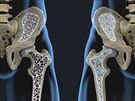 kosti, osteoporza